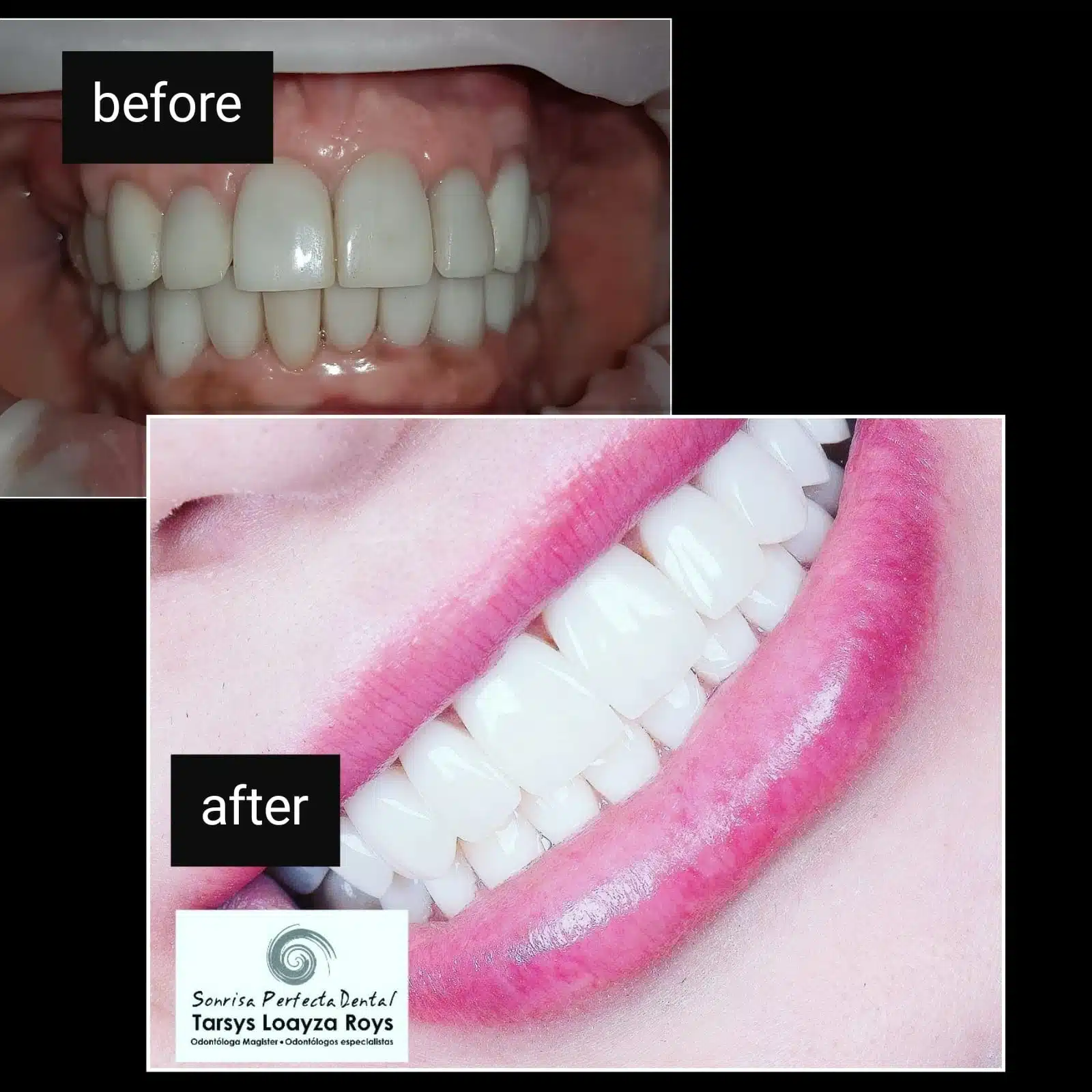 | Sonrisa Renaissance Hollywood antes y despues Sonrisa Renaissance Hollywood antes y despues